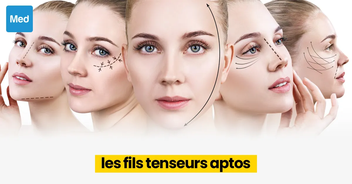 Les fils tenseurs APTOS: un lifting sans chirurgie